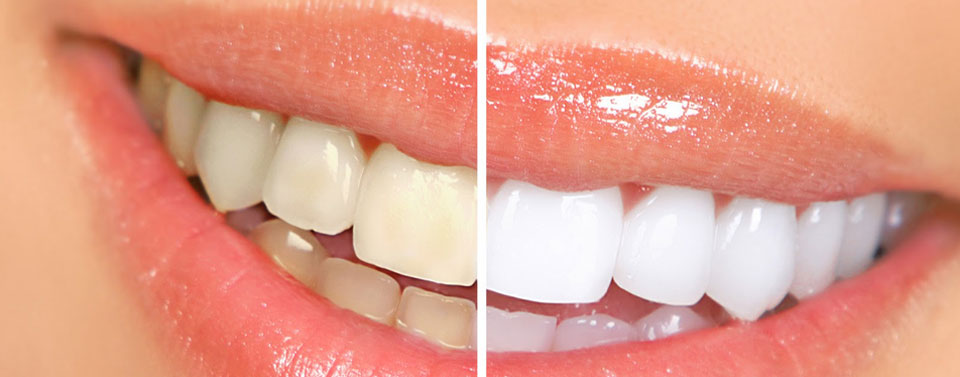 Cosa è lo sbiancamento dentale?